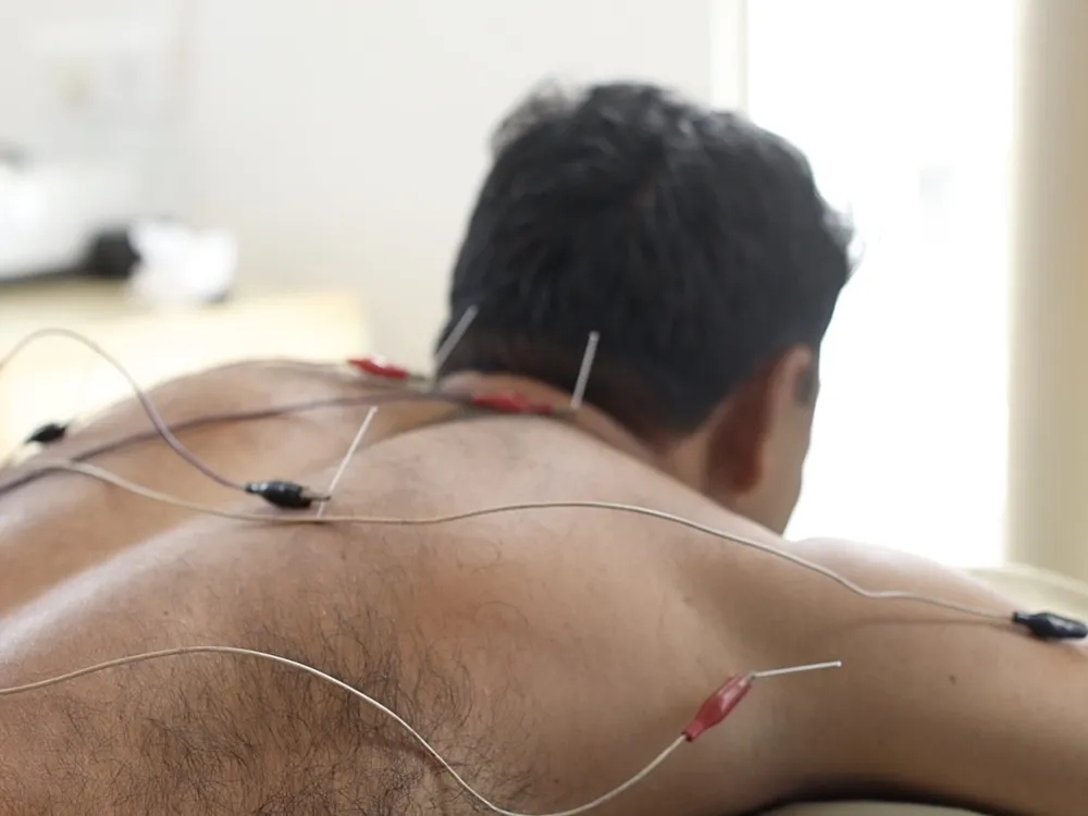 Acupuncture Sessions